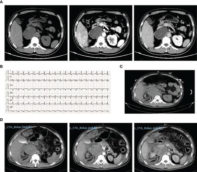 Case Report: Surgical Intervention Under Pheochromocytoma Multisystem Crisis: Timing and Approach